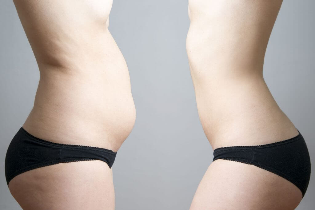 Exploring the Best Tummy Tucker Options and Liposuction for a Trimmed Waistline